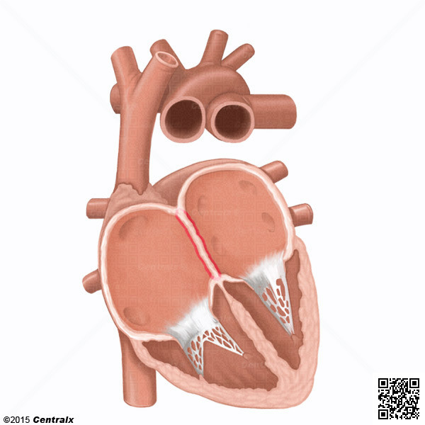 Tabique Interatrial