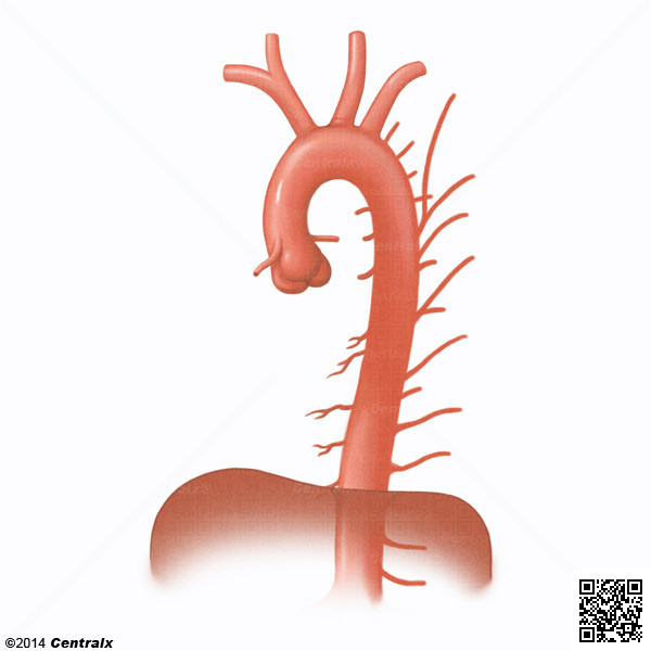 Aorta Torcica