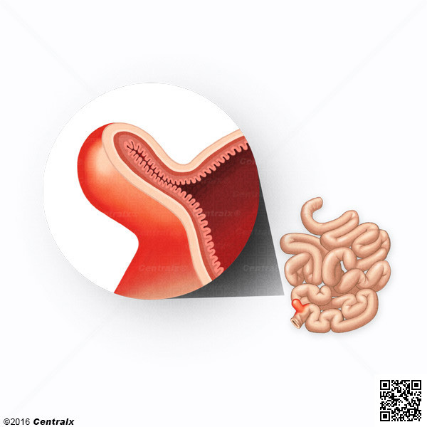 Divertculo Ileal