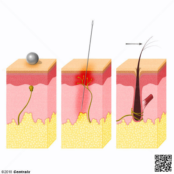 Mecanorreceptores