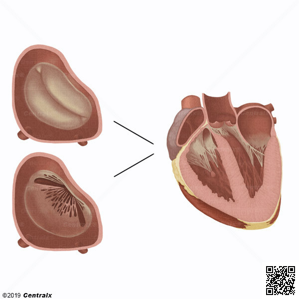 Vlvula Mitral