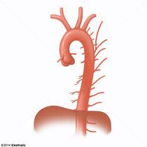 Aorta Torcica